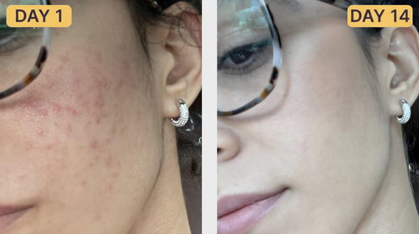 Breakouts Cleared Up Without Drying Me Out