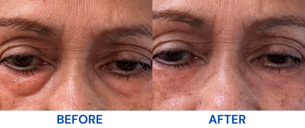 Under-Eye Bags & Puffiness