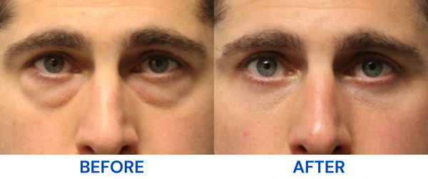 Dark Circles & Puffiness