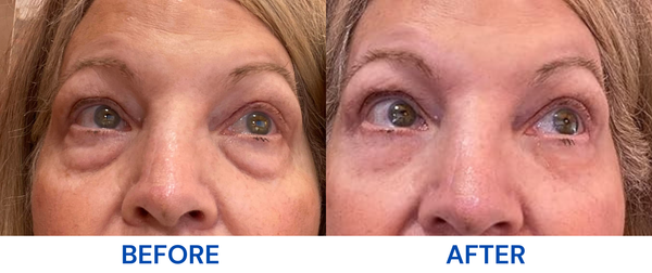 Genetic Under-Eye Bags